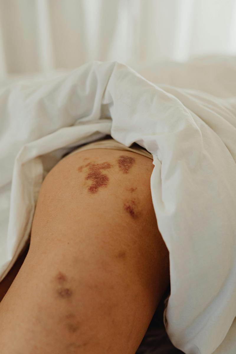 bruised skin remedies-9ca155cb678641fa80c13cc03e00923f.jpg bruised skin remedies