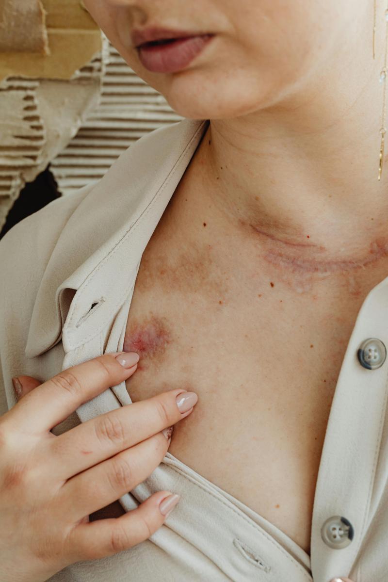 bruised skin remedies-9ca155cb678641fa80c13cc03e00923f.jpg bruised skin remedies