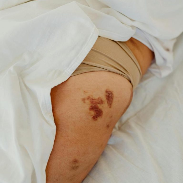 bruised-skin-remedies-e05114fdca6b430b8540e1b3d0f15f3b