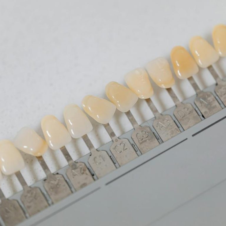 porcelain-veneers-f6a8dfd13e354e93a87c44e558def84d