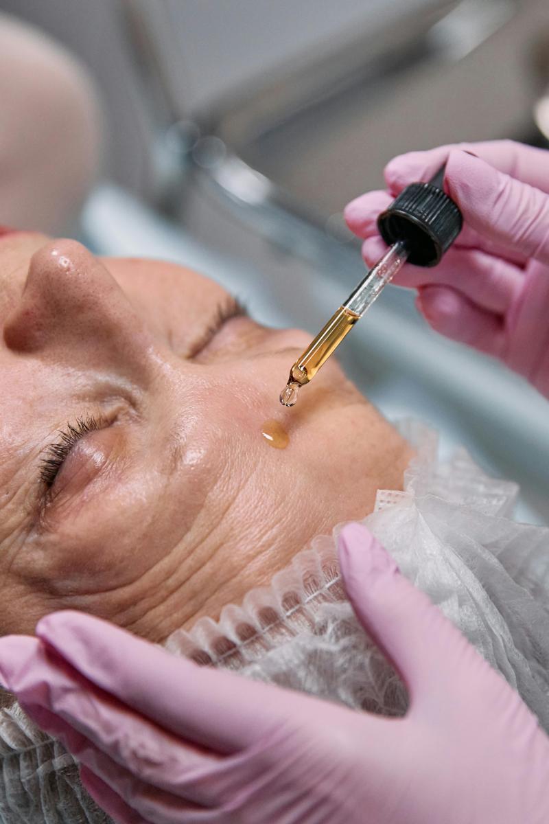 microneedling treatment